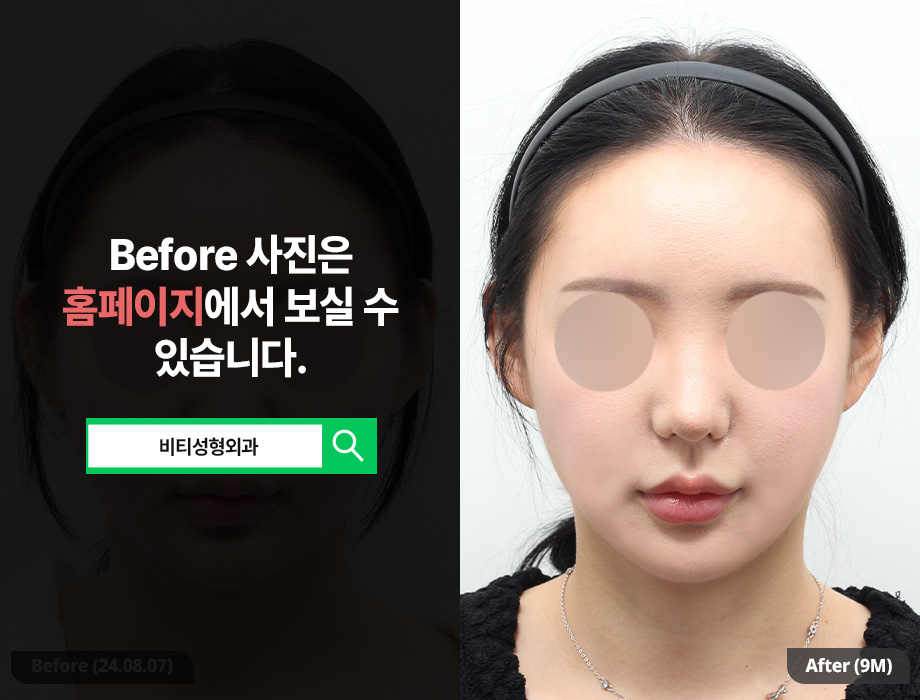 The Real 9-Month Update! Honest Review of BT Plastic Surgery Facial Contouring Type 1 + Face Liposuction image 1