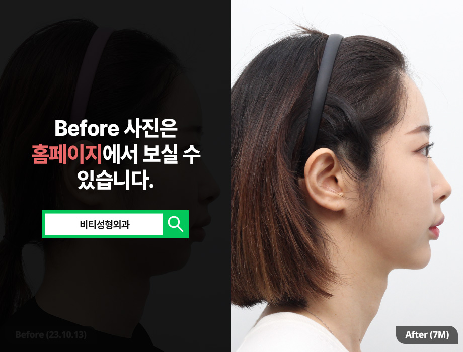 Cheekbone + Square Jaw + Receding Chin Surgery: A Facial Contouring Combination That Balances Face Shape image 3
