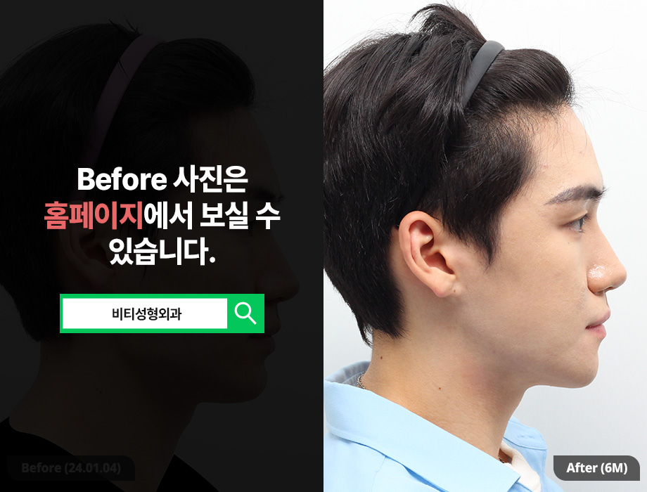 남자 윤곽수술, 여자랑 똑같이 하면 안되는 이유 관련 이미지 3