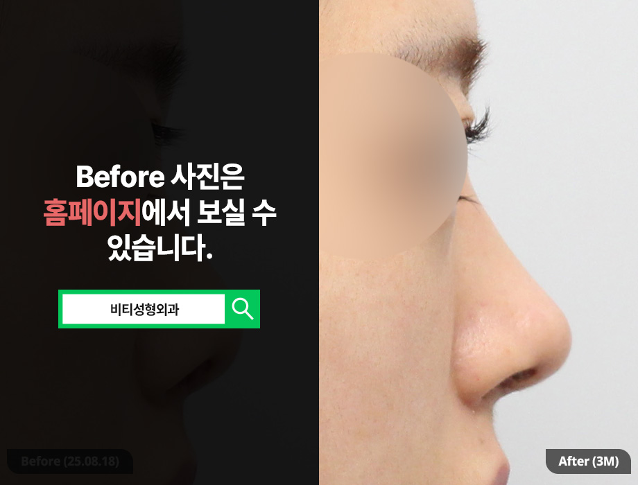 No More Failures! How to Choose a Clinic for Revision Nose Surgery? image 1