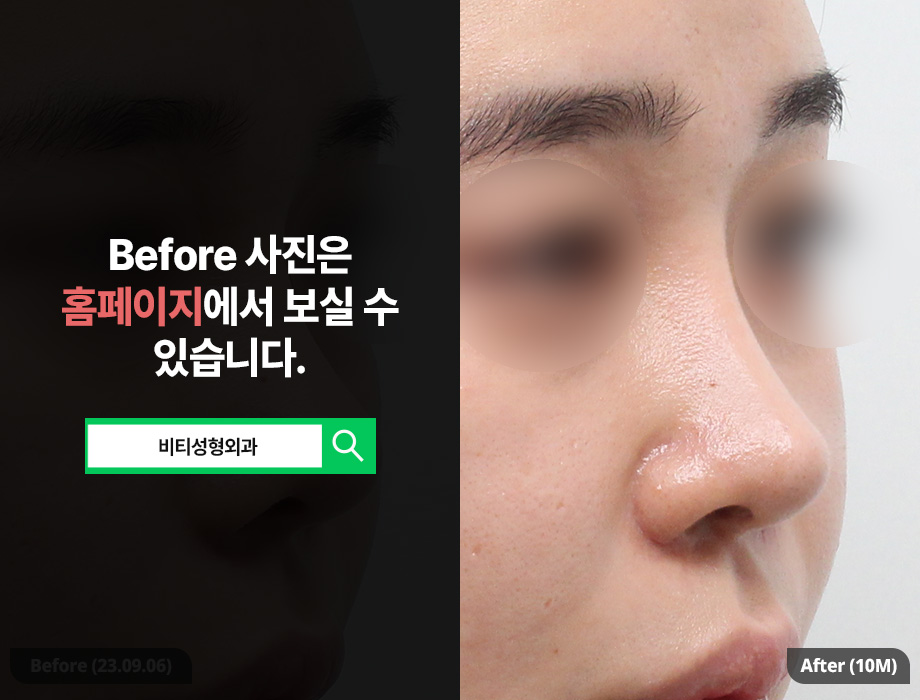 코 재수술, 왜 기증늑 연골이 필요한가? 복코, 콧볼까지 한 번에 해결! 관련 이미지 2