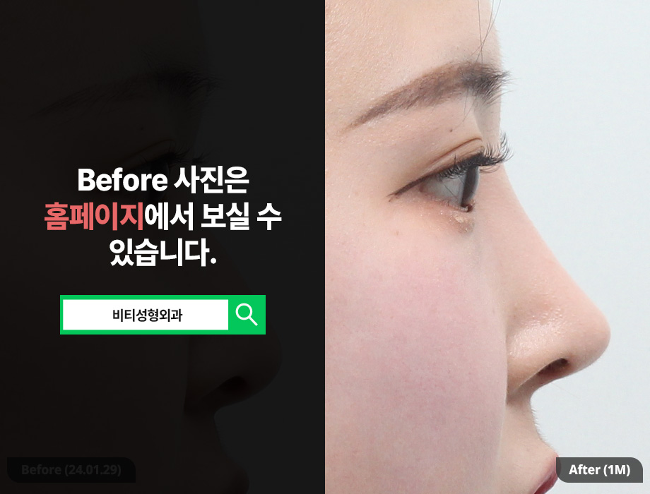 매부리코 복코 필러로는 안되는 이유! 관련 이미지 1