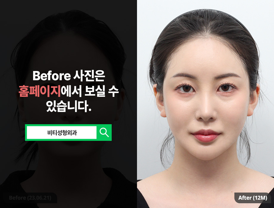 환자에게 딱 맞춘 안면윤곽 효과 관련 이미지 1