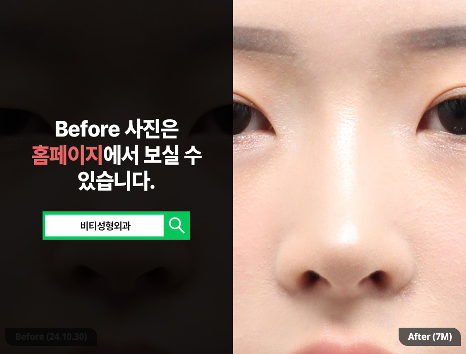 매부리코 + 콧볼축소, 한 번에 수술해야 좋은 이유? 관련 이미지 3