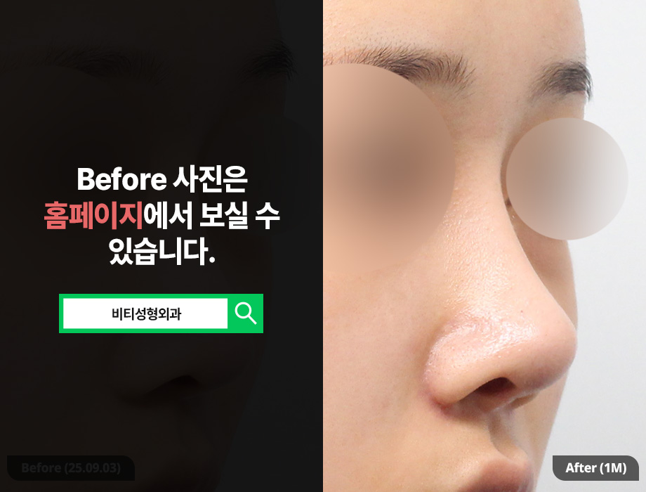 Silicone vs. Rib Cartilage? The Perfect Combination for Rhinoplasty Revision You Won’t Regret Even 10 Years Later image 2