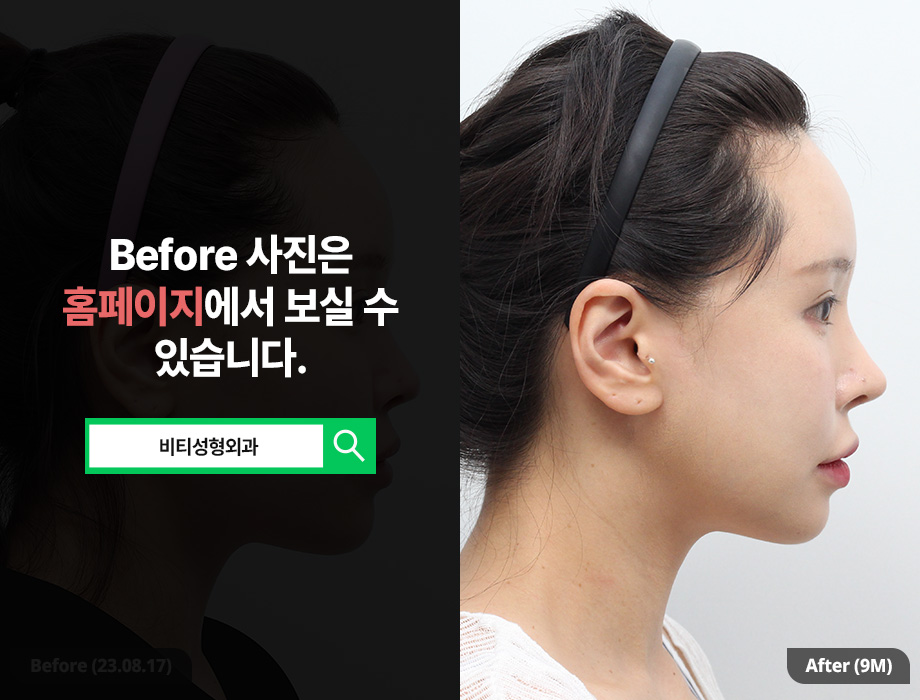 턱 여백 줄이고 작아진 얼굴! 윤곽 3종 리얼후기 관련 이미지 3