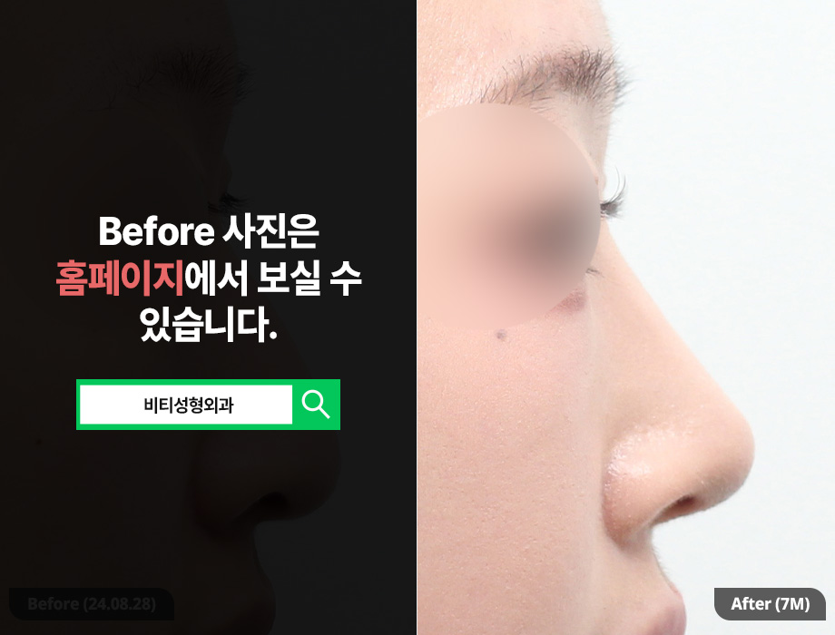 Non-implant Rhinoplasty, Novo Nose Surgery (Hump Nose + Bulbous Nose) 7-Month Real Review image 1