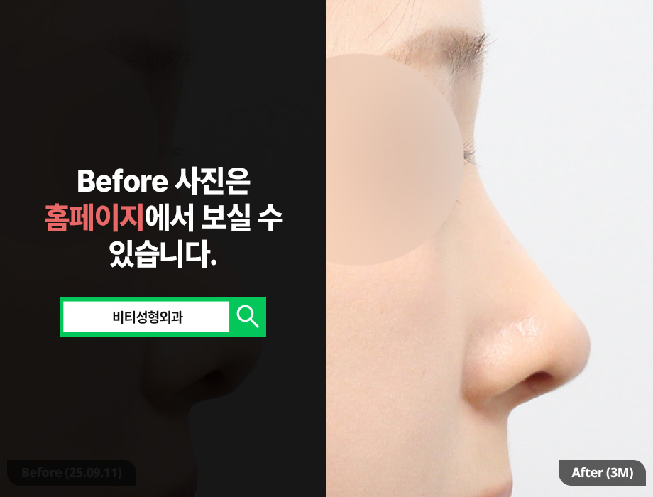 무보형물 코성형 노보코 3개월 후기🔥 매부리·복코·비순각까지 한번에 관련 이미지 1