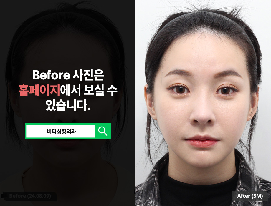 What Should You Check When Considering Facial Contouring Surgery? • A Real 3-Month Review of Contouring Surgery image 1