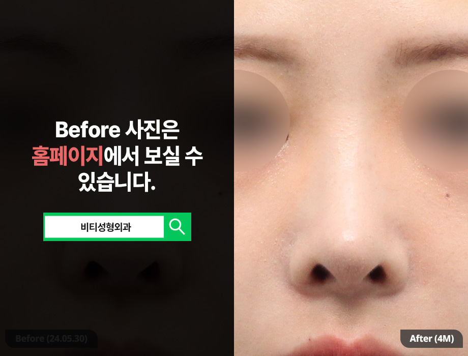 복코에 짧은 코까지, 재수술로 가능할까? 관련 이미지 3