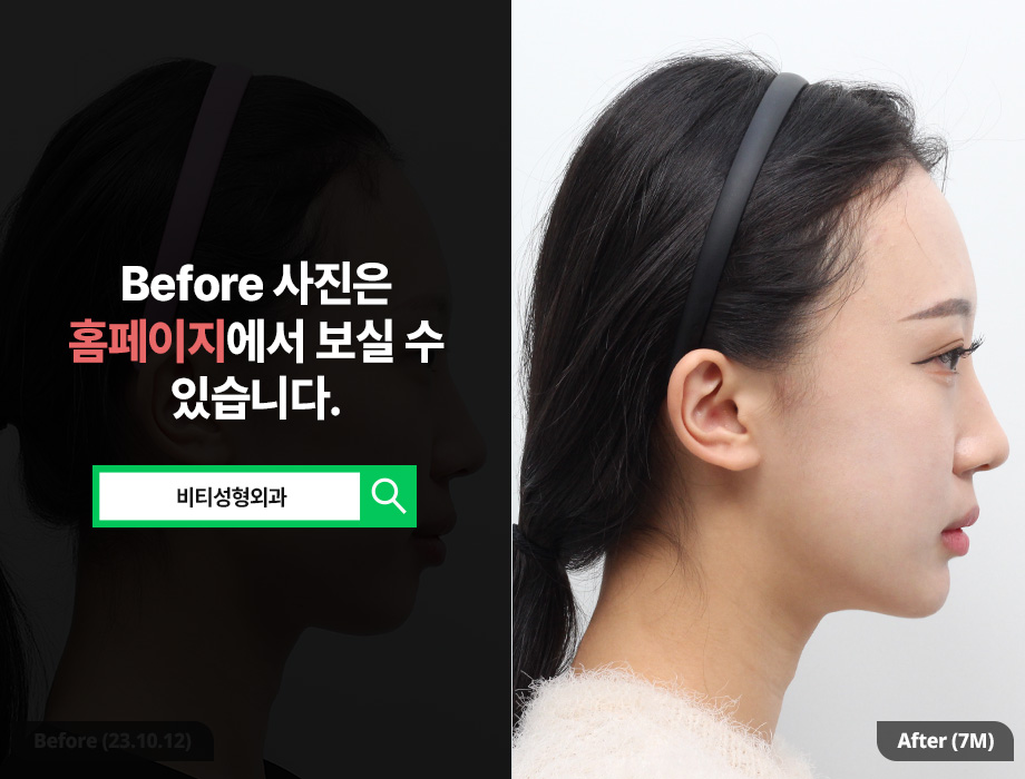 무턱+비대칭 얼굴형, 윤곽 3종으로 개선 가능할까? 관련 이미지 3
