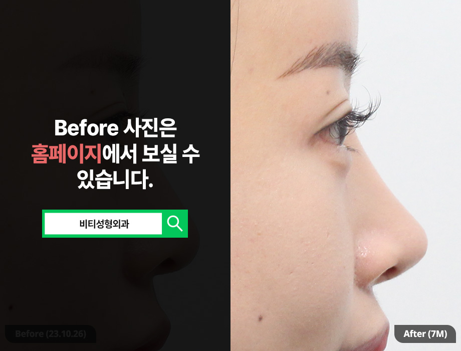 기증늑연골로 다시 태어난 코라인, 코재수술 7개월 후기+비용은? 관련 이미지 1