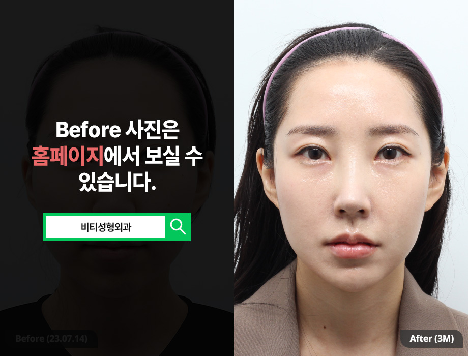 윤곽수술+얼굴지방흡입 동시 진행으로 효과 2배!! 관련 이미지 1