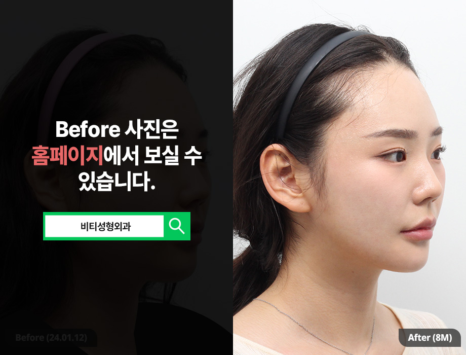 3-Part Facial Contouring, 8-Month Real Review After Long-Curved Square Jaw Surgery! image 2