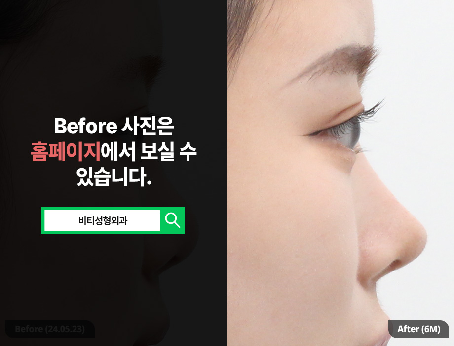 한국에서 코 재수술, 일본인도 찾는 이유? 관련 이미지 1