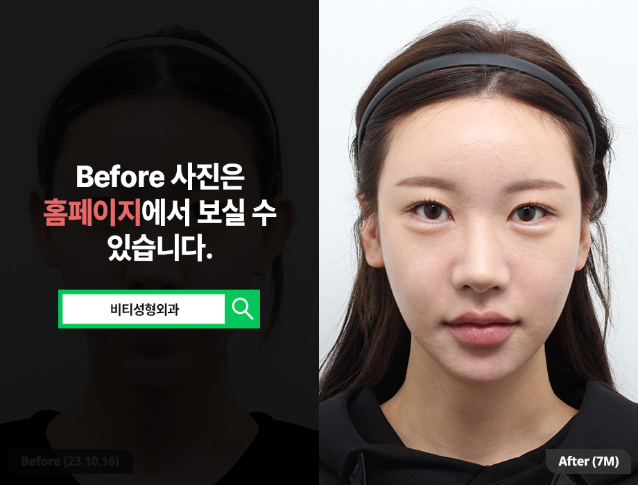 Why Choose Contouring Surgery Instead of Filler? The Differences and Effects of the 3 Procedures image 1