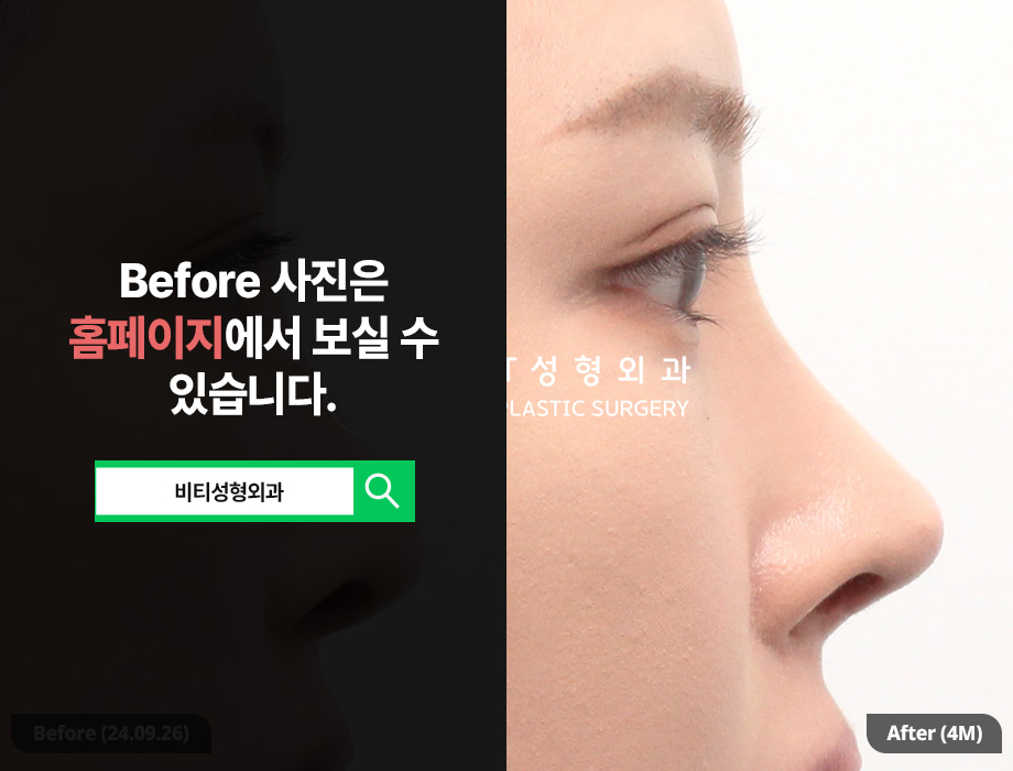 코재수술, 기능과 디자인 한번에! 기능미용코 4개월 찐후기 관련 이미지 1
