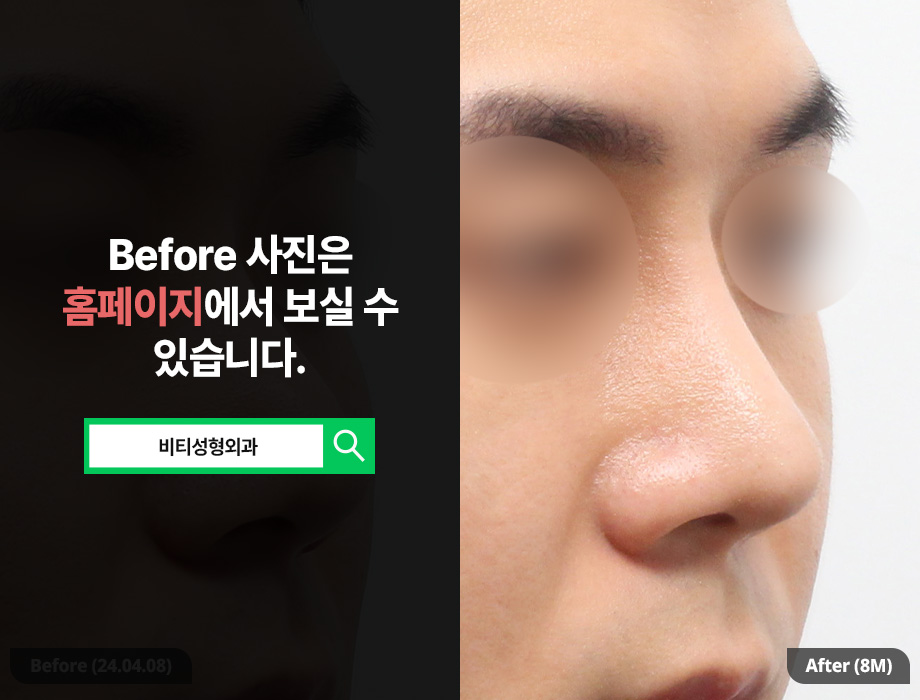 남자코 고민이라면? 매부리부터 실제거까지 한 번에 관련 이미지 2