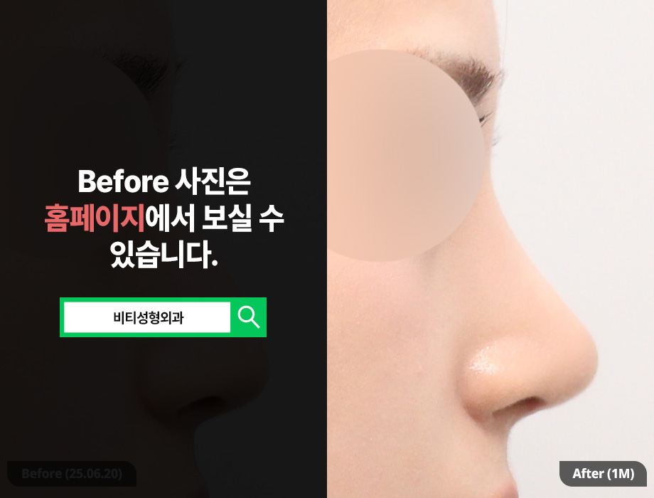 무보형물 코성형 장단점을 확실히 알아보고 관련 이미지 1