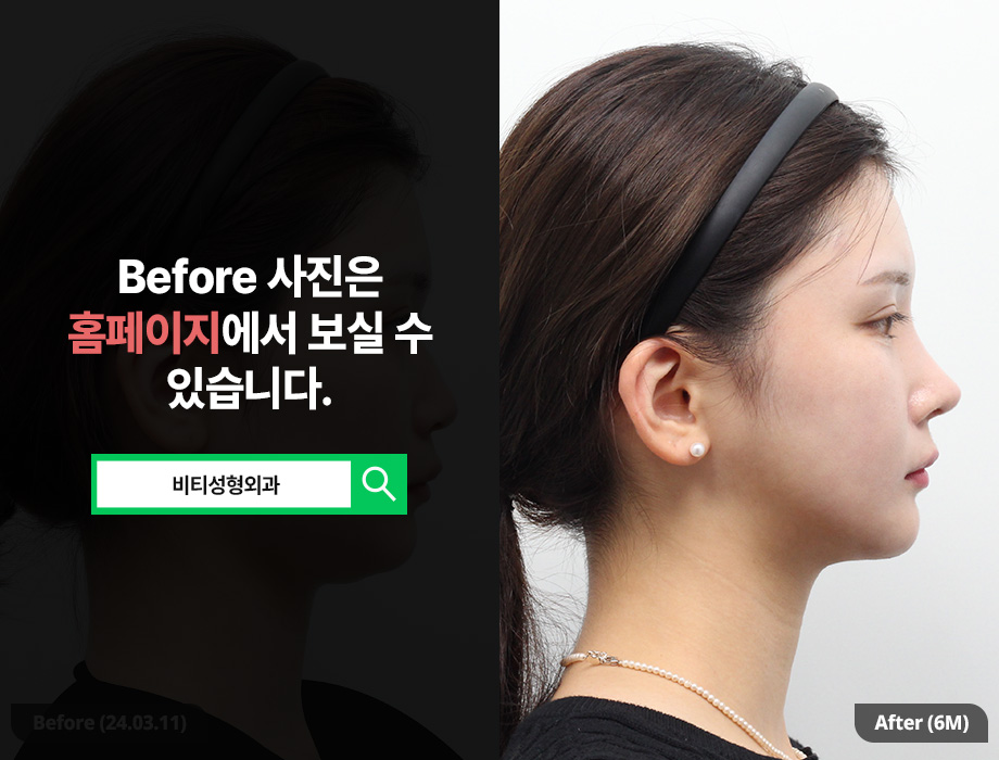 나에게 딱 맞춘 안면윤곽, 비티 퍼스널 라인🫧 관련 이미지 3