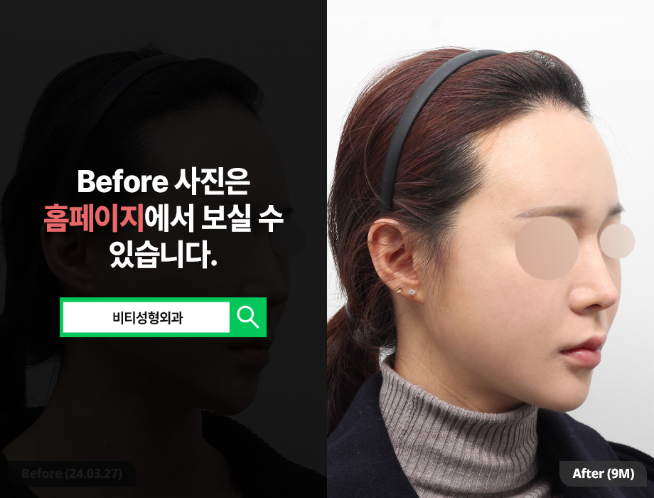 얼굴이 작은데 윤곽수술 해도 되나요? 작고 각진 얼굴 9개월 후기 관련 이미지 2