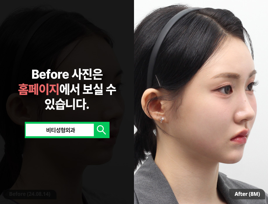[비티성형외과] 자려한 윤곽 3종 | 자연스러우면서 화려한 V라인, 8개월 찐후기 관련 이미지 2