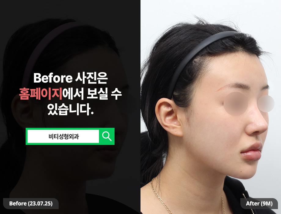 얼굴 지흡까지 해야 갸름해지는 이유, 9개월 변화로 증명 관련 이미지 2