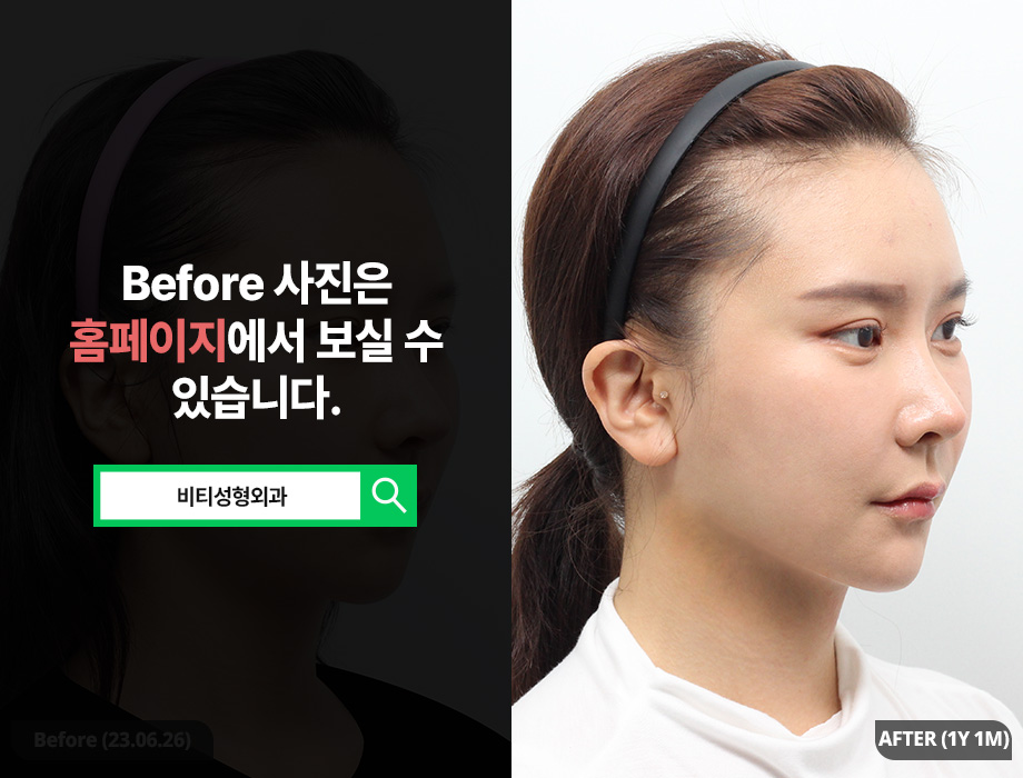 A Real Review 1 Year After Surgery for Minimizing Cheekbone Reduction Side Effects image 2