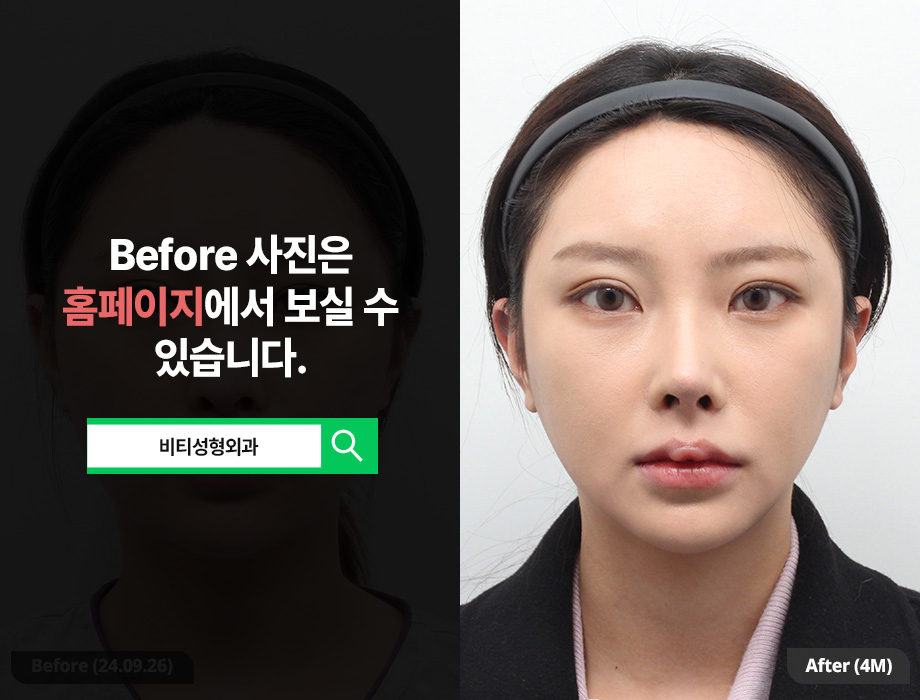 윤곽3종 + 이중턱 지방흡입 4개월 진짜후기!! 관련 이미지 1