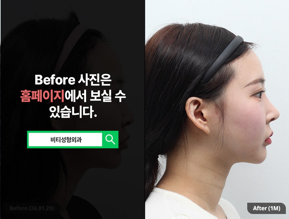 윤곽3종 + 얼굴지방흡입, 요즘 트렌드는? 1개월 리얼후기 관련 이미지 3