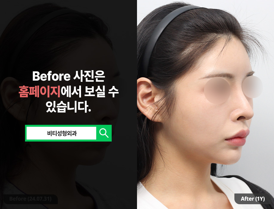 Three Types of Contouring Surgery: Three Structural Reasons the Face Looks Smaller image 2
