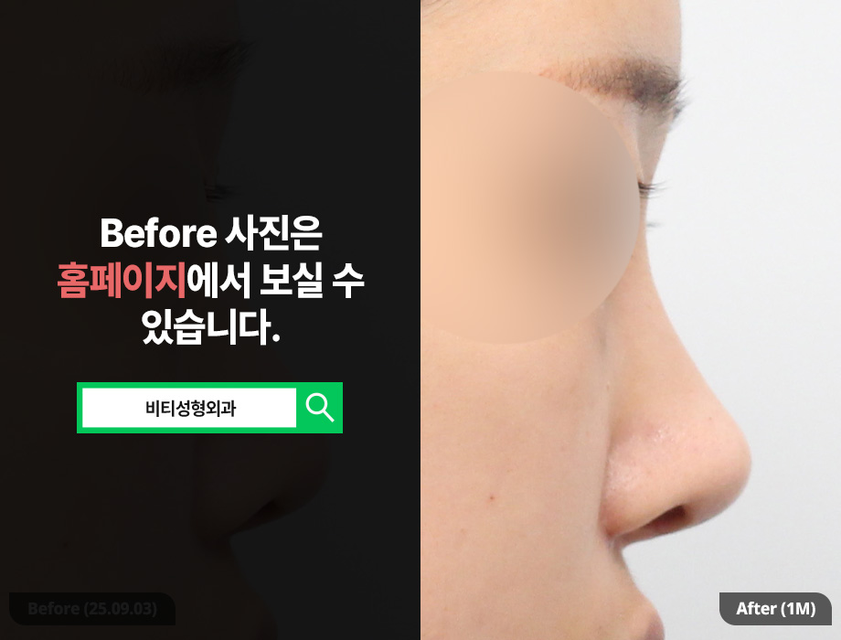 Silicone vs. Rib Cartilage? The Perfect Combination for Rhinoplasty Revision You Won’t Regret Even 10 Years Later image 1