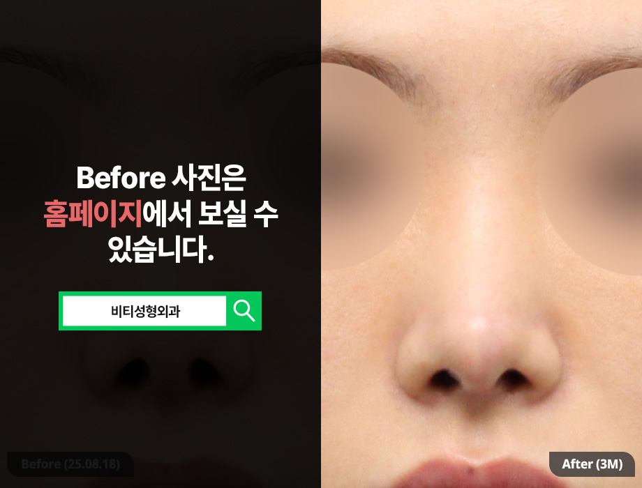 No More Failures! How to Choose a Clinic for Revision Nose Surgery? image 3