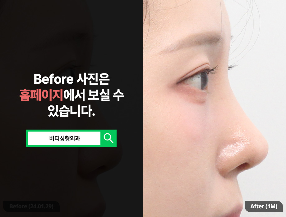 Can donated rib cartilage nose surgery improve a bulbous nose and the nasolabial angle, too? image 1