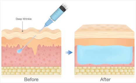 Samseong Jungang Station Dermatology Full Face Filler image 2