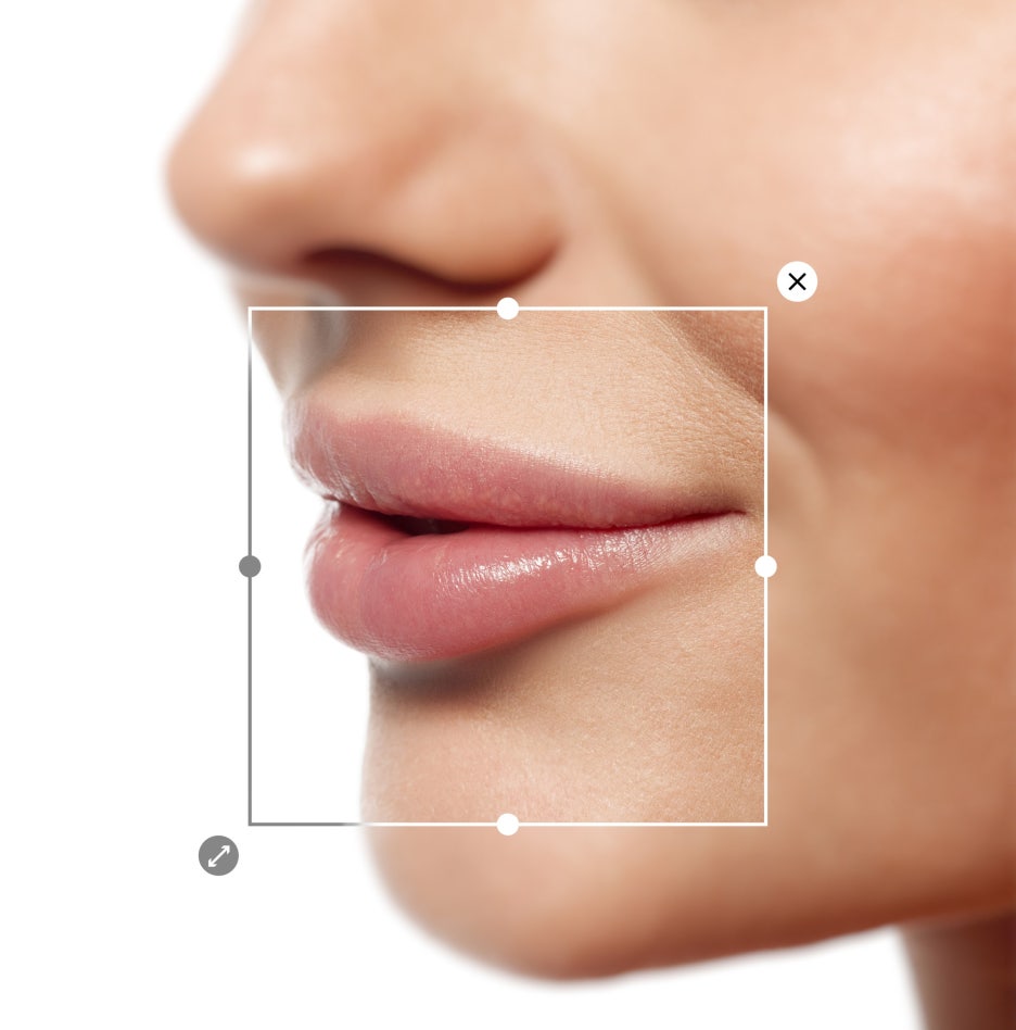 Samsung Station Dermatology Clinic, Lip Filler: It May Look Simple, but It Is by No Means a Simple Procedure. image 2