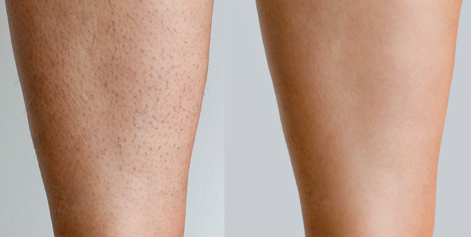 Gangnam Dermatology Clinic Hair Removal: How to Move Away from Irritating Self-Hair Removal | Laser Hair Removal image 5