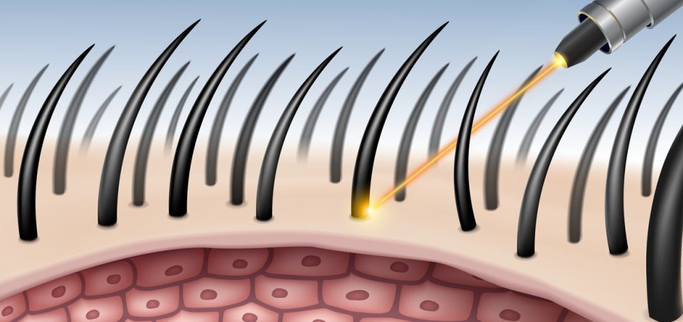 Gangnam Dermatology Clinic Hair Removal: How to Move Away from Irritating Self-Hair Removal | Laser Hair Removal image 4