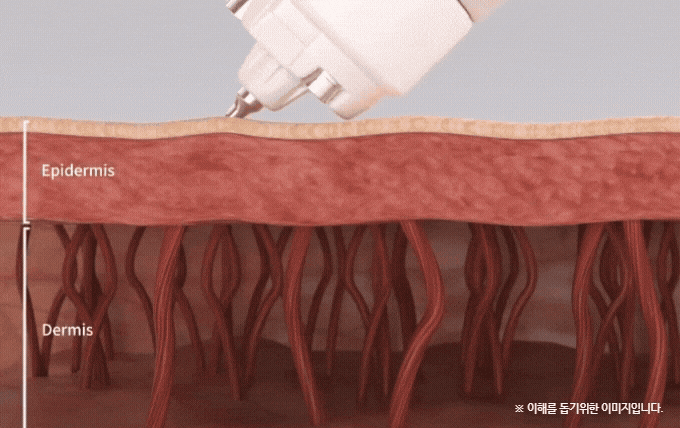 Samsung Station Dermatology Clinic Recommendation, Scar Treatment Without Needles? What Are the Principle and Effects of Cure-Jet? image 6