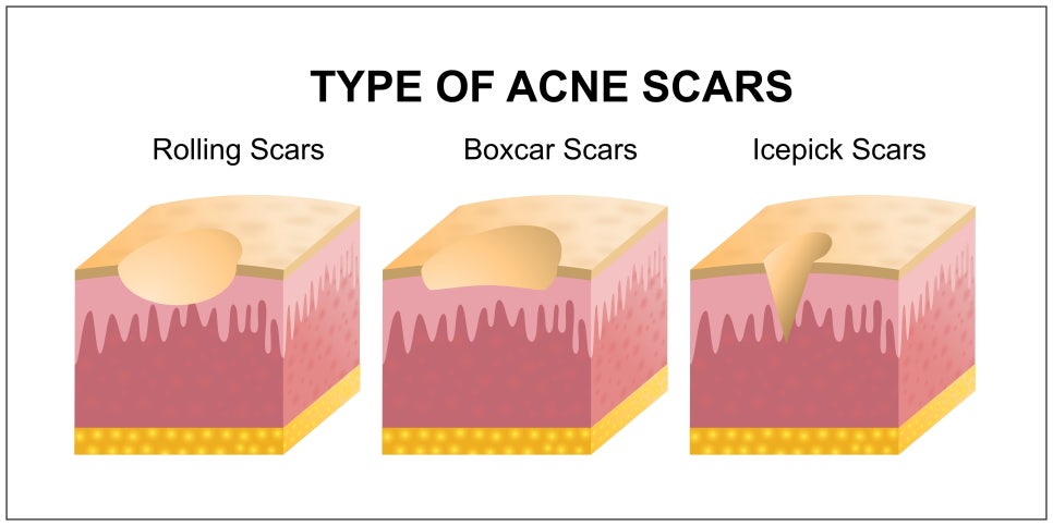 Samsung Station Dermatology Clinic Recommendation, Scar Treatment Without Needles? What Are the Principle and Effects of Cure-Jet? image 7
