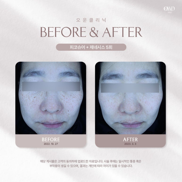 봉은사역피부과, 쉽게 사라지지 않는 색소질환으로 고민중이시라면? | 듀얼토닝 관련 이미지 3