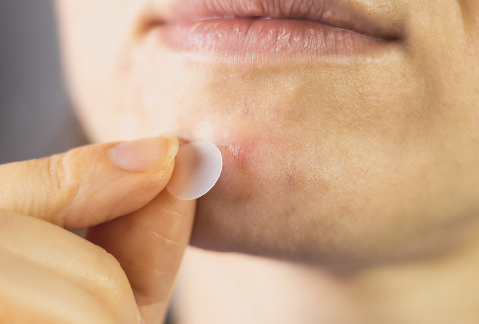 Samseong-dong Acne Treatment, The Key Is Preventing Recurrence. | Capri Laser image 2
