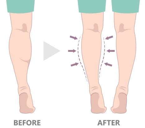 봉은사역근처피부과, 발달한 종아리와 승모근, 다이어트 만으로는 해결하기 어렵습니다. | 바디보톡스 관련 이미지 6