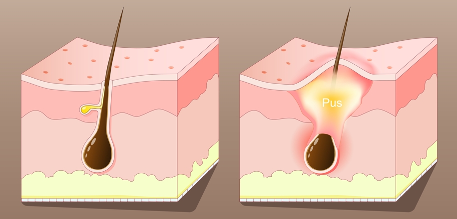 Gangnam Dermatology Clinic Hair Removal: How to Move Away from Irritating Self-Hair Removal | Laser Hair Removal image 3