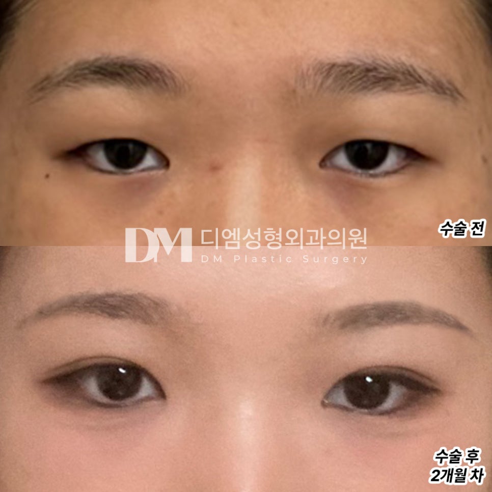 Blepharoplasty Review. "It settled naturally into the shape I wanted!" image 2
