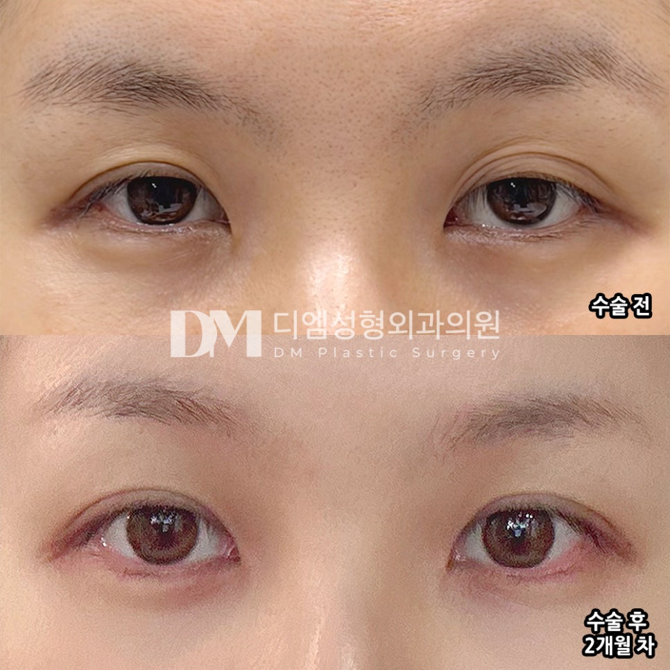 디엠 눈매교정/눈성형 후기, “과한 유도 없어서 편안하게 받았습니다!” 관련 이미지 2