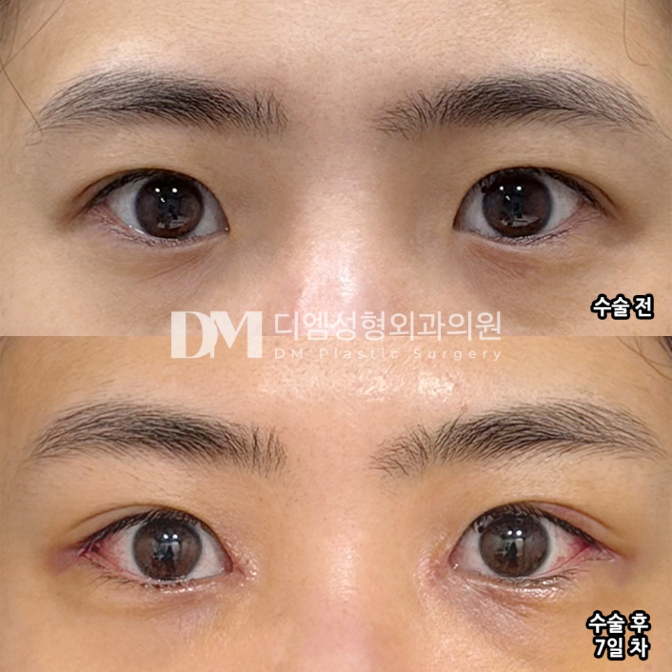 DM Medial/Lateral and Lower Canthoplasty Surgery Review: “I’m satisfied with the natural-looking results!” image 2