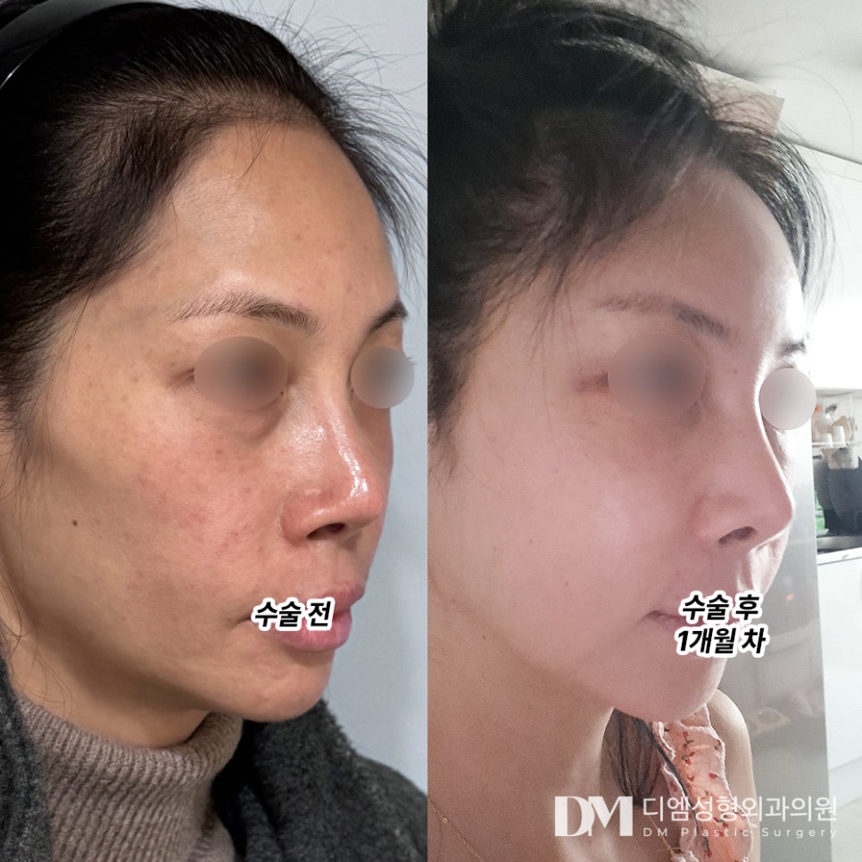 얼굴지방이식 후기."동안 되어서 너무나 만족해요!" 관련 이미지 2