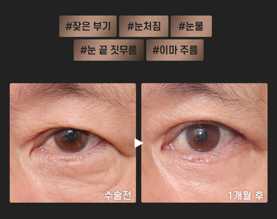 Escape Drooping Eyes and Renew Your Eye Area for a More Youthful Look image 9