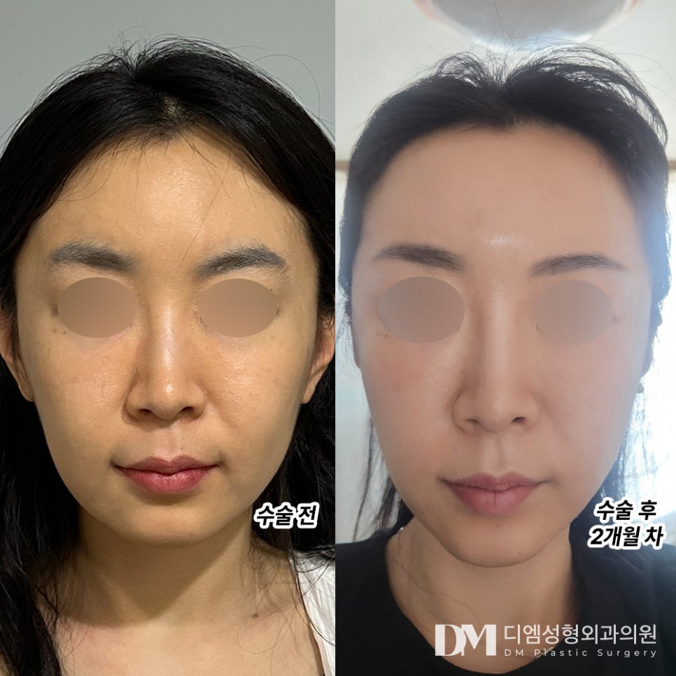 Mid-Facelift Review. "The swelling is all gone, and the sensation has fully returned!" image 2